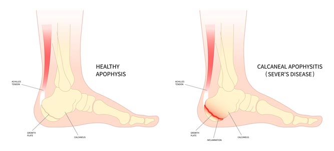 Common Foot Problems in Children - Foot And Ankle